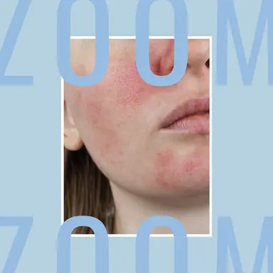 Les gammes anti-rougeurs