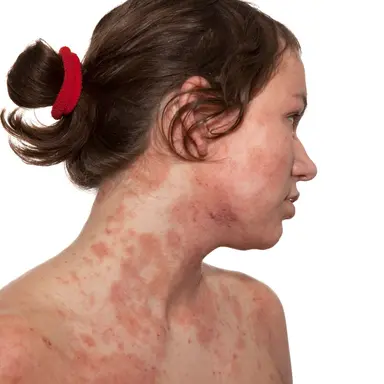 Maladies de peau : une lutte au quotidien